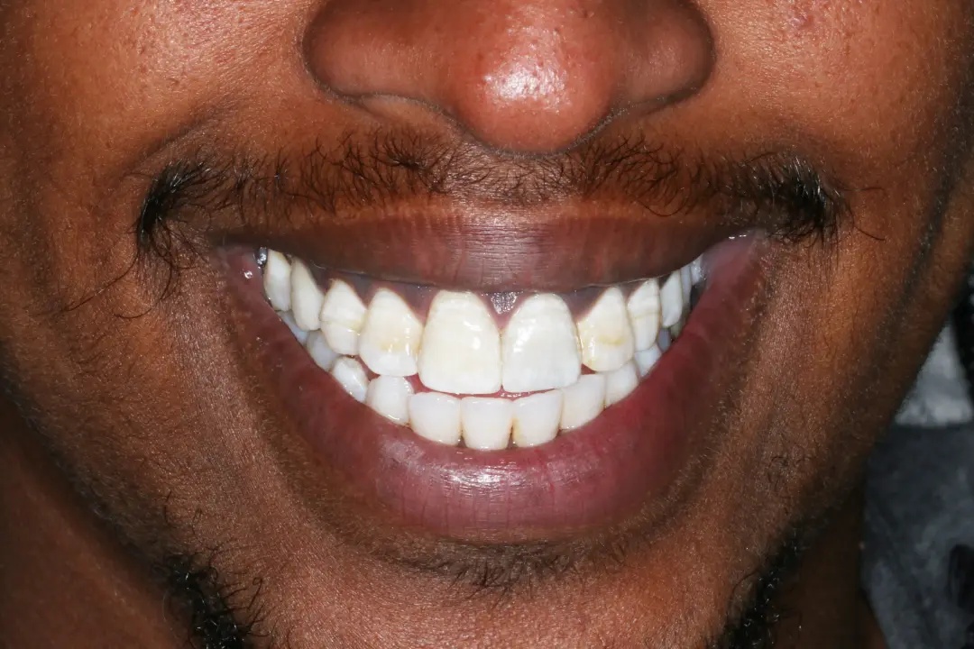 Abshir before after dental treatment