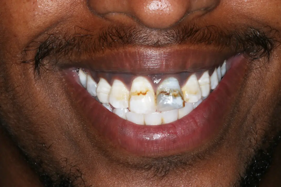 Abshir before after dental treatment