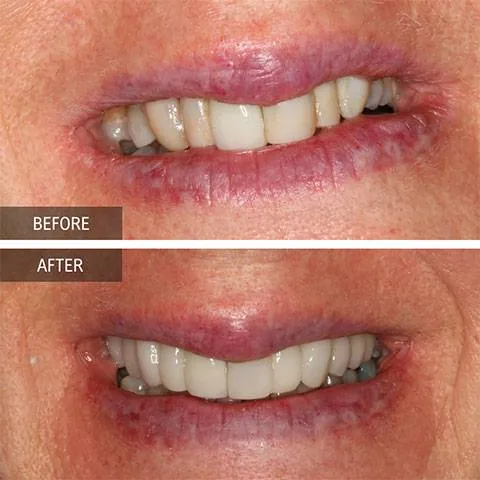 DOI---Crowns-3