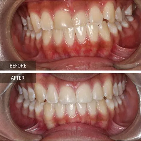 DOI---Invisalign-1