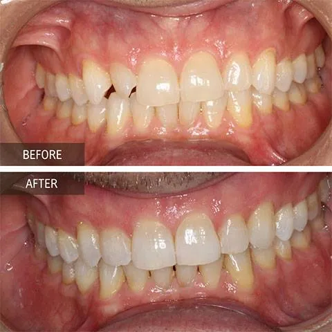 DOI---Invisalign-2