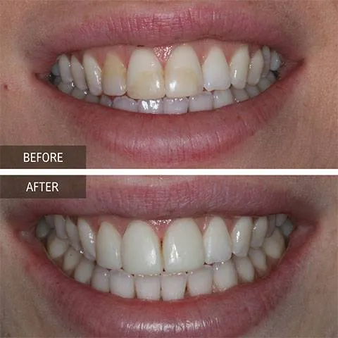 DOI---Invisalign-3