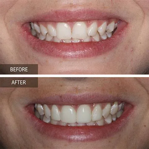 Invisalign clear aligners with elastics