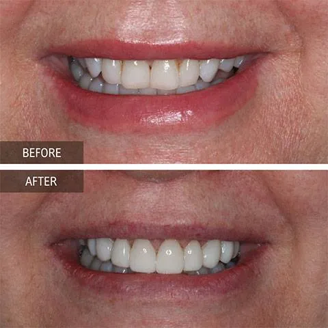 DOI---Smile-Makeover-5