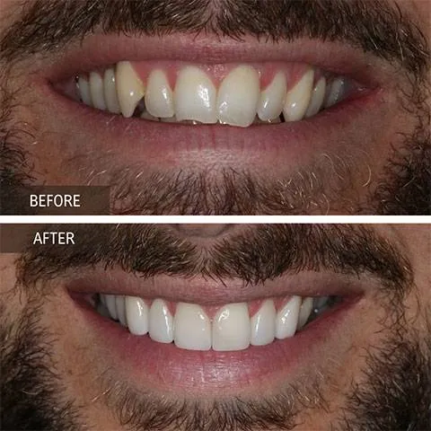 DOI---Veneers-2
