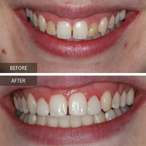 DOI---Veneers-3