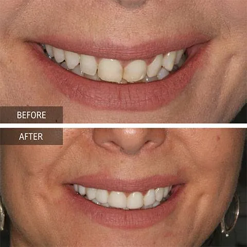 DOI---Veneers-4