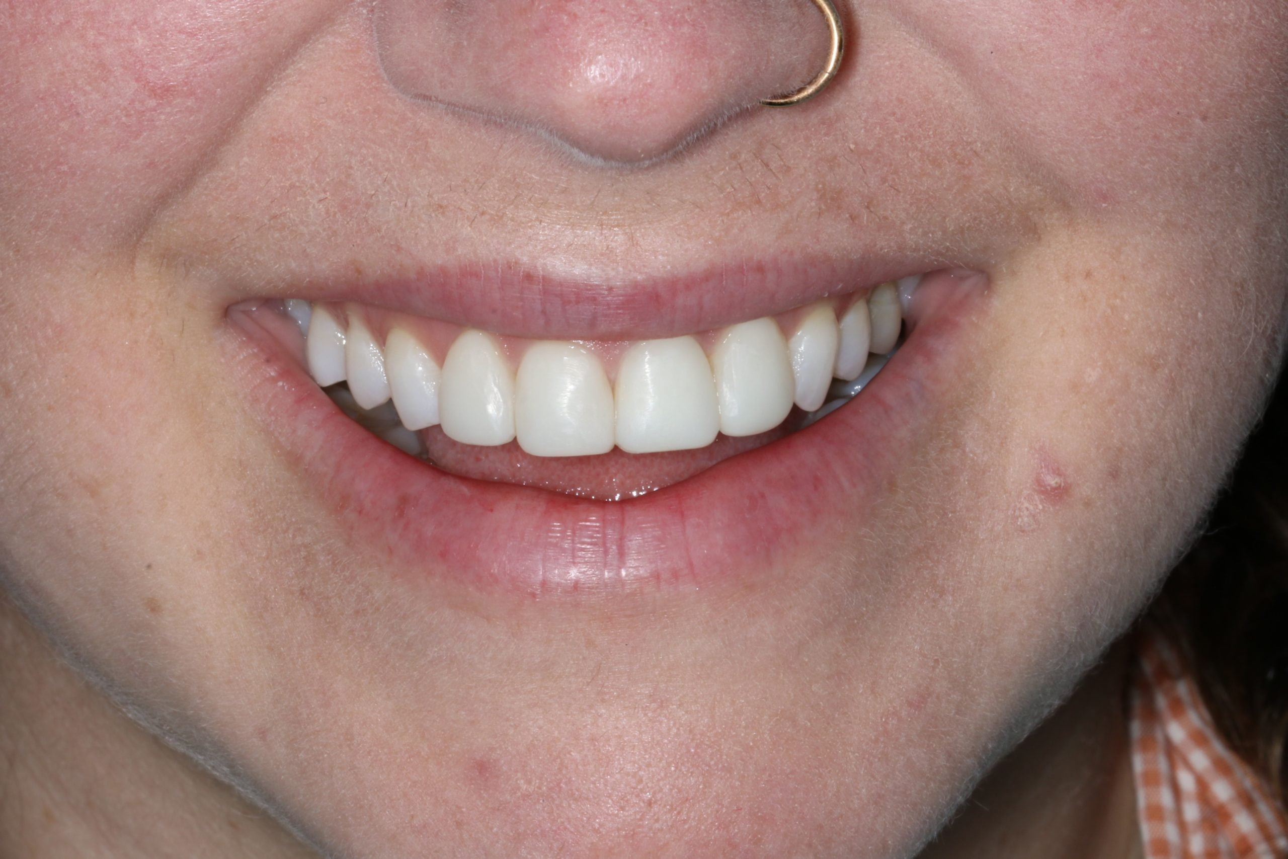 Sophie before after dental treatment