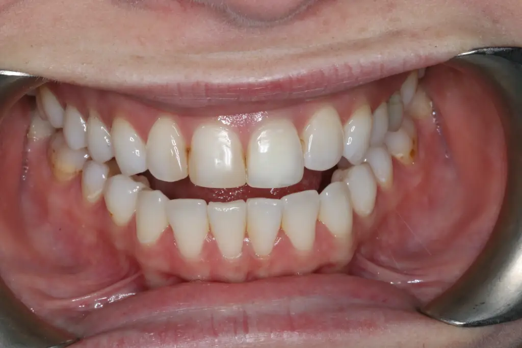 Sophie before after dental treatment