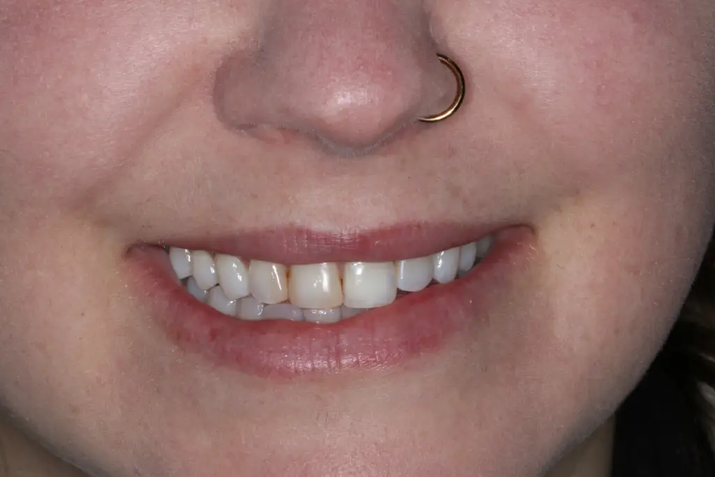 Sophie before after dental treatment