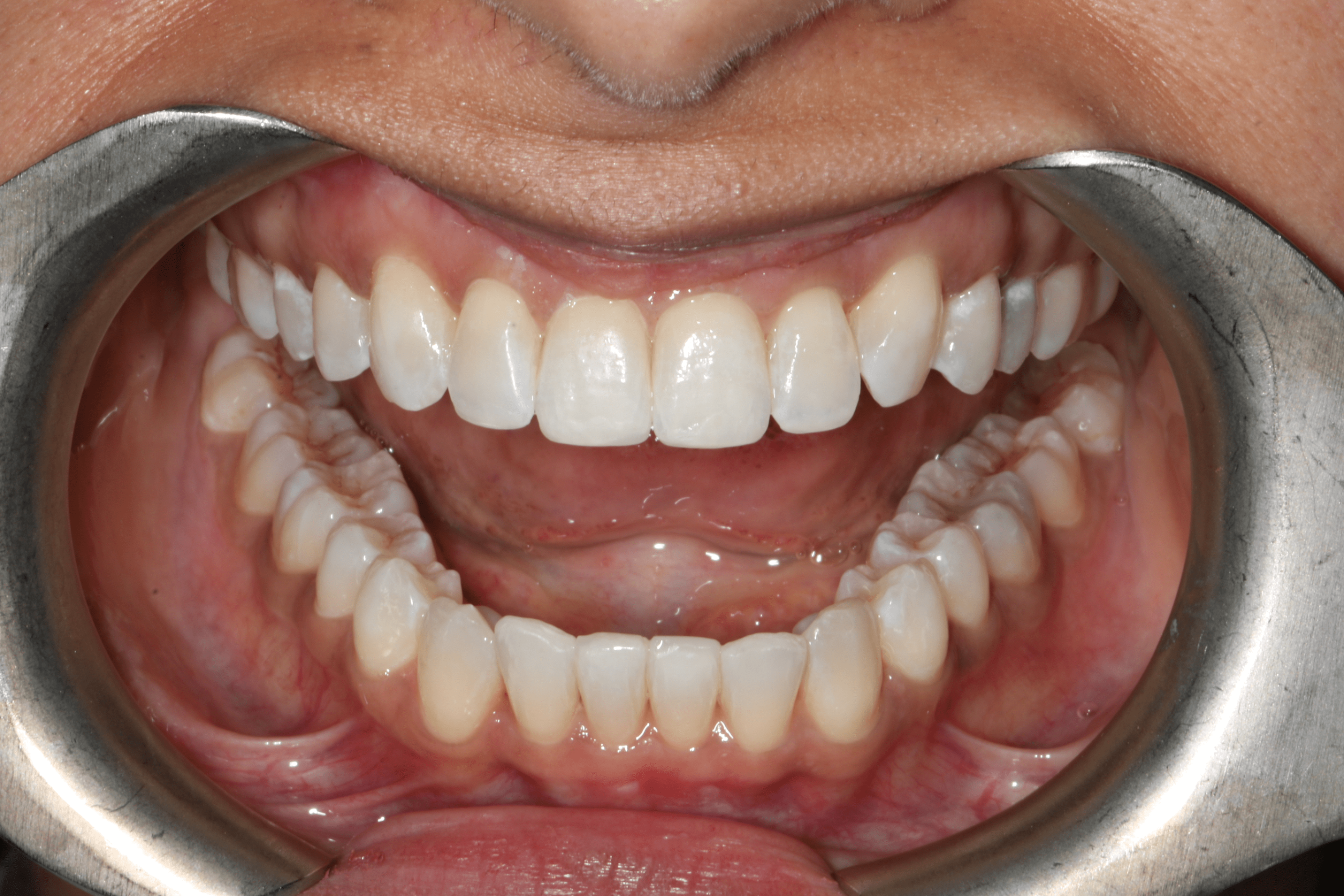 Rashmi before after dental treatment