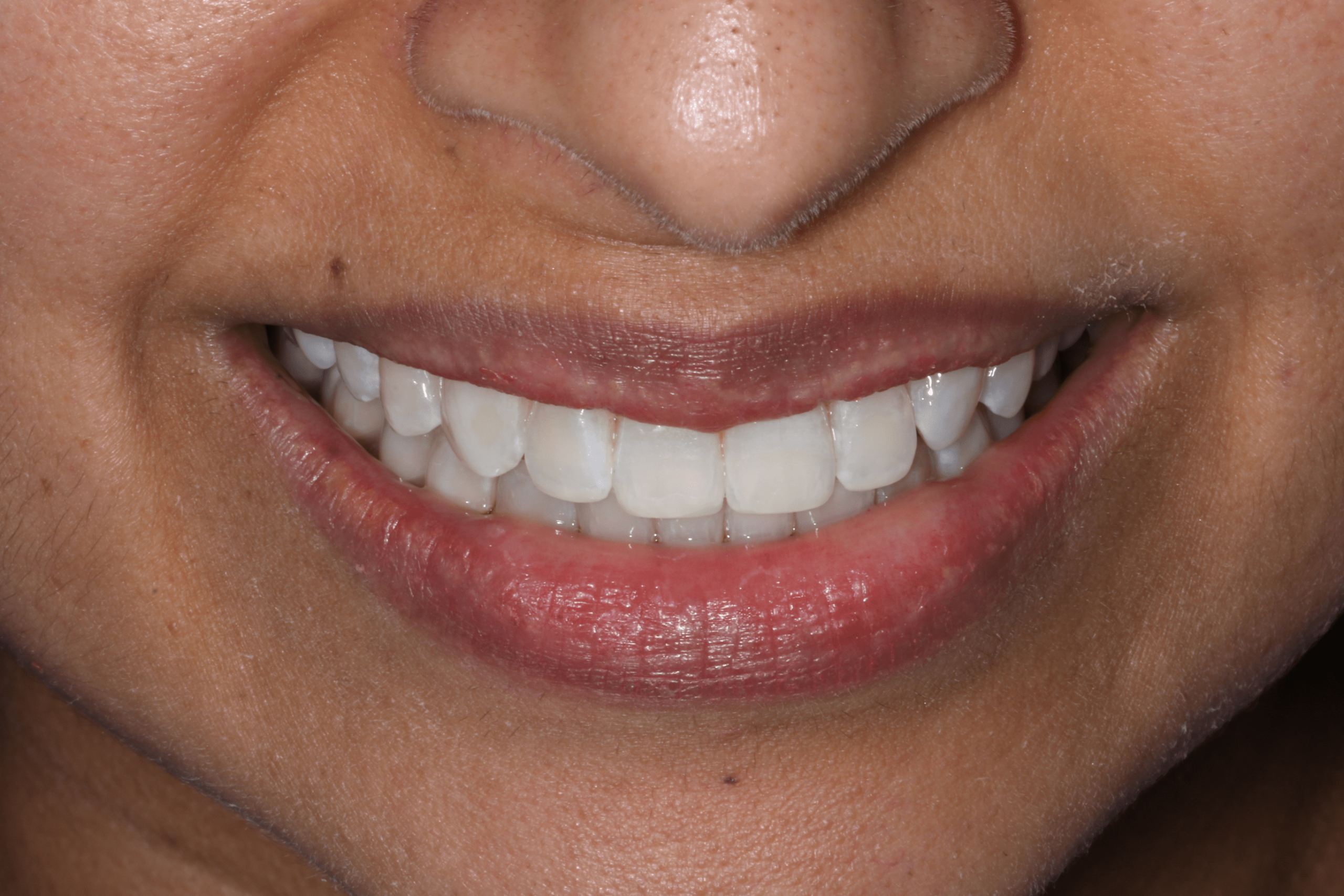 Rashmi before after dental treatment