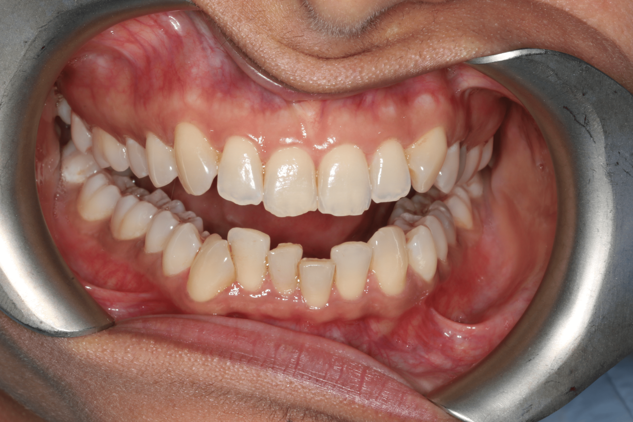 Rashmi before after dental treatment