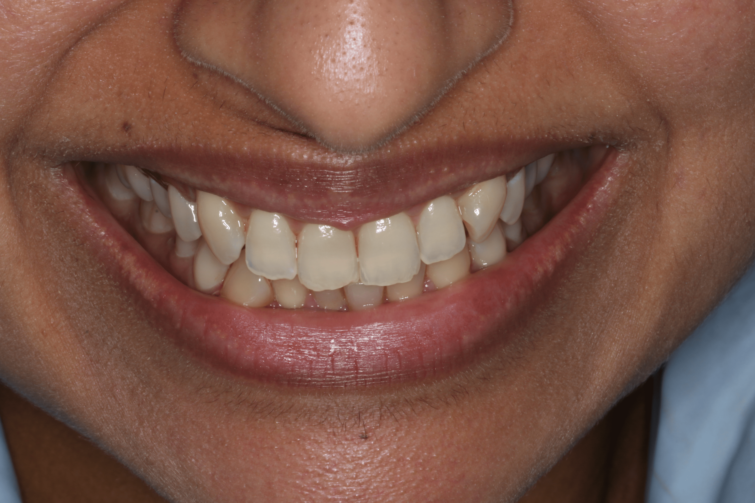 Rashmi before after dental treatment