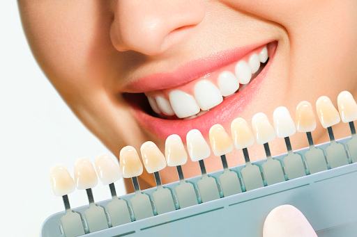 Porcelain Veneers