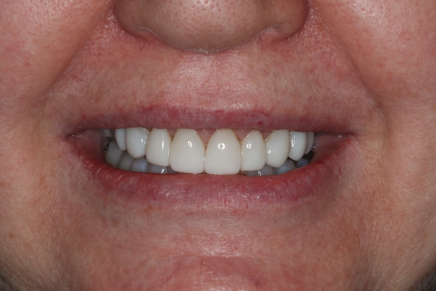 Marisa before after dental treatment