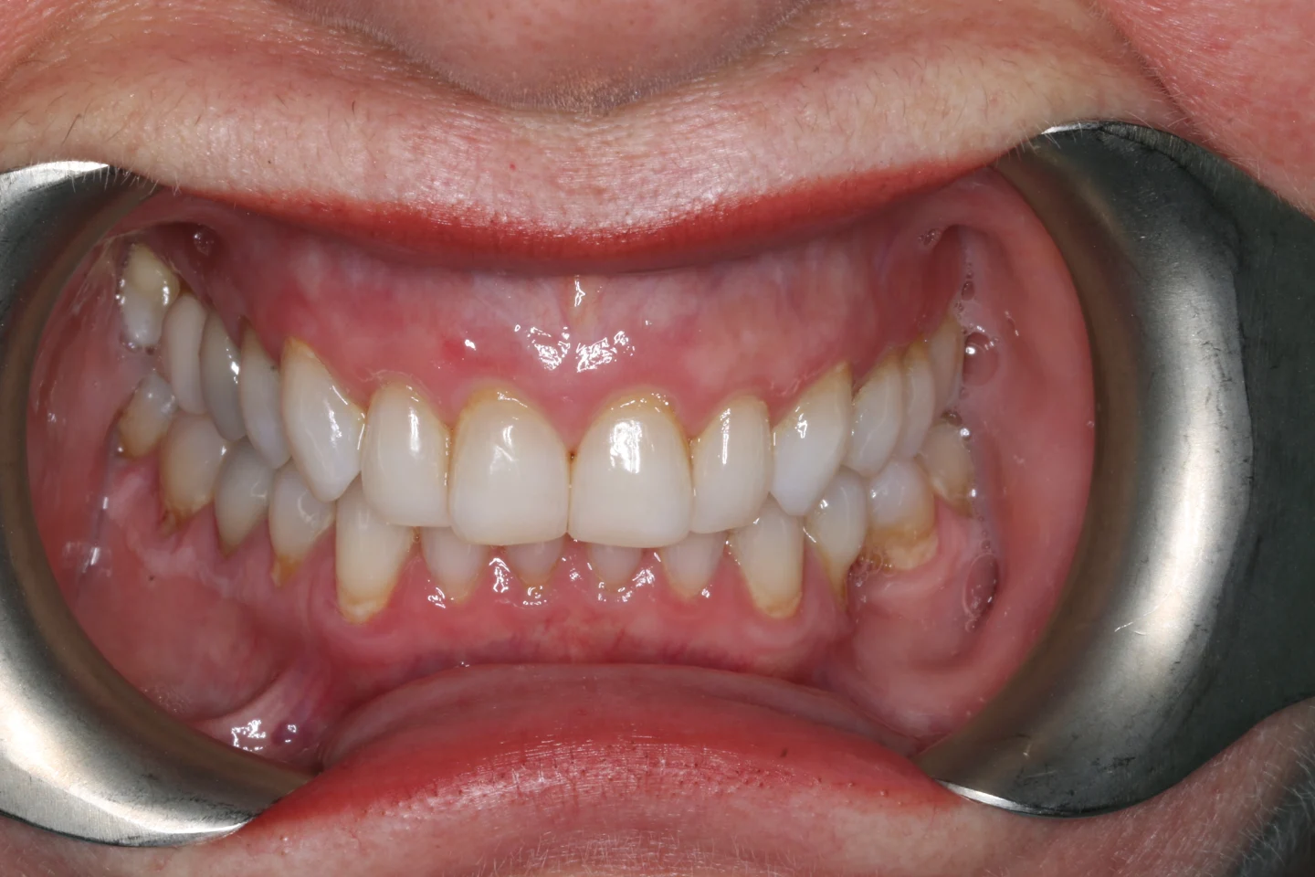 Marisa before after dental treatment