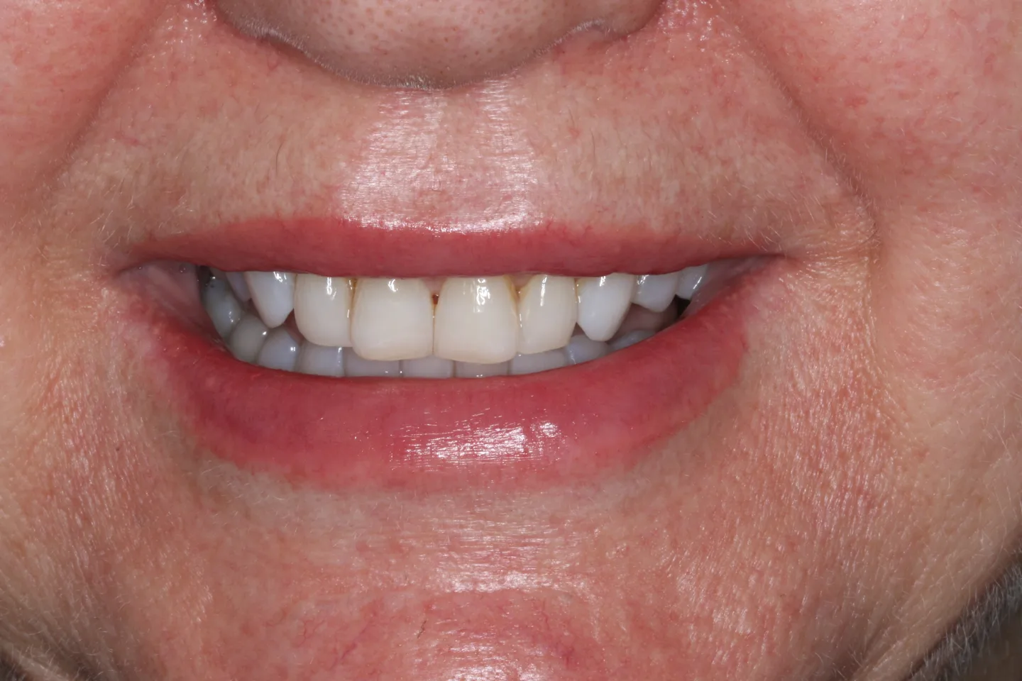 Marisa before after dental treatment