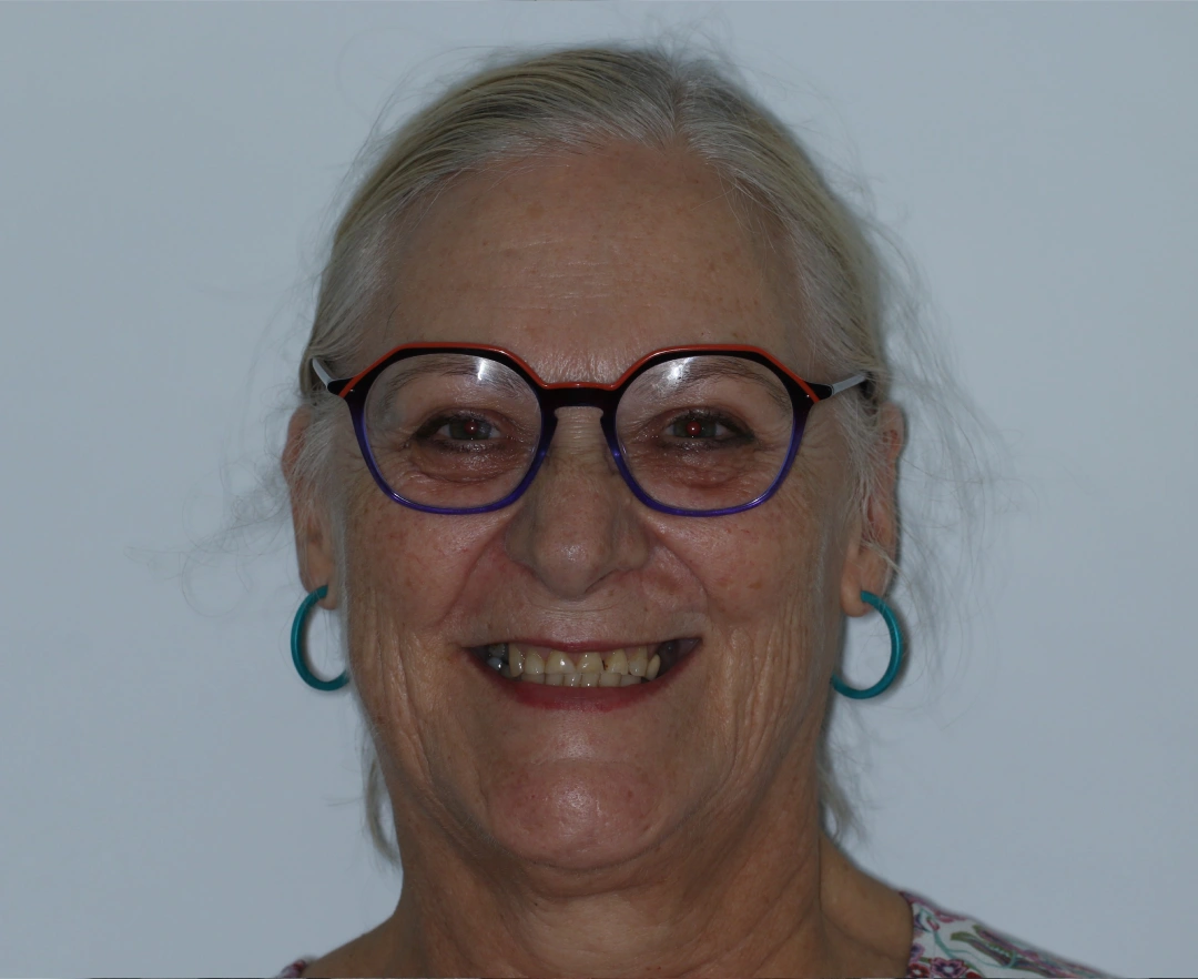 Naomi before after dental treatment