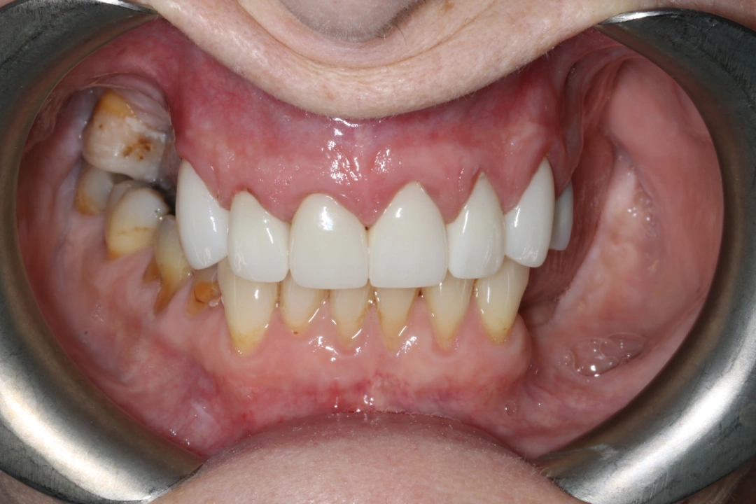 Naomi before after dental treatment