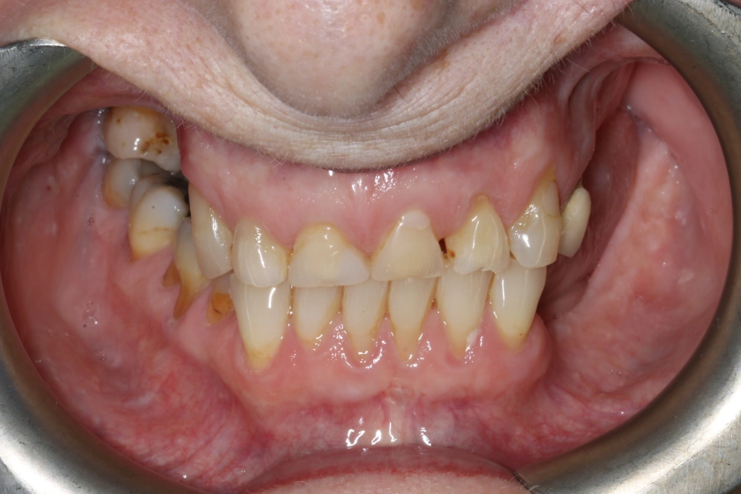 Naomi before after dental treatment