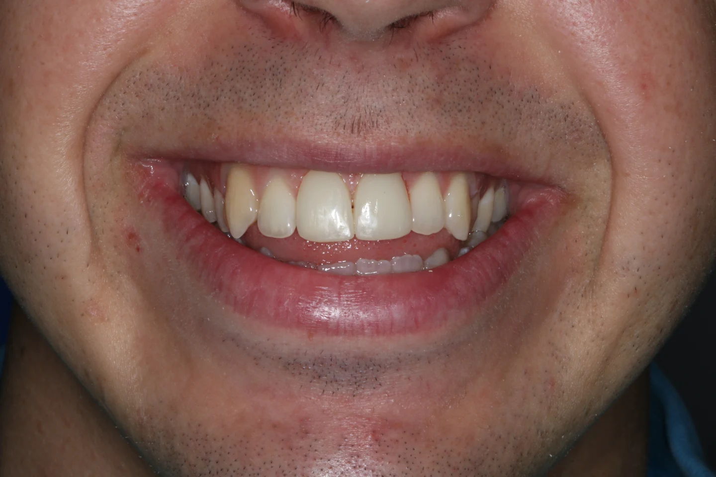 Ryan before after dental treatment