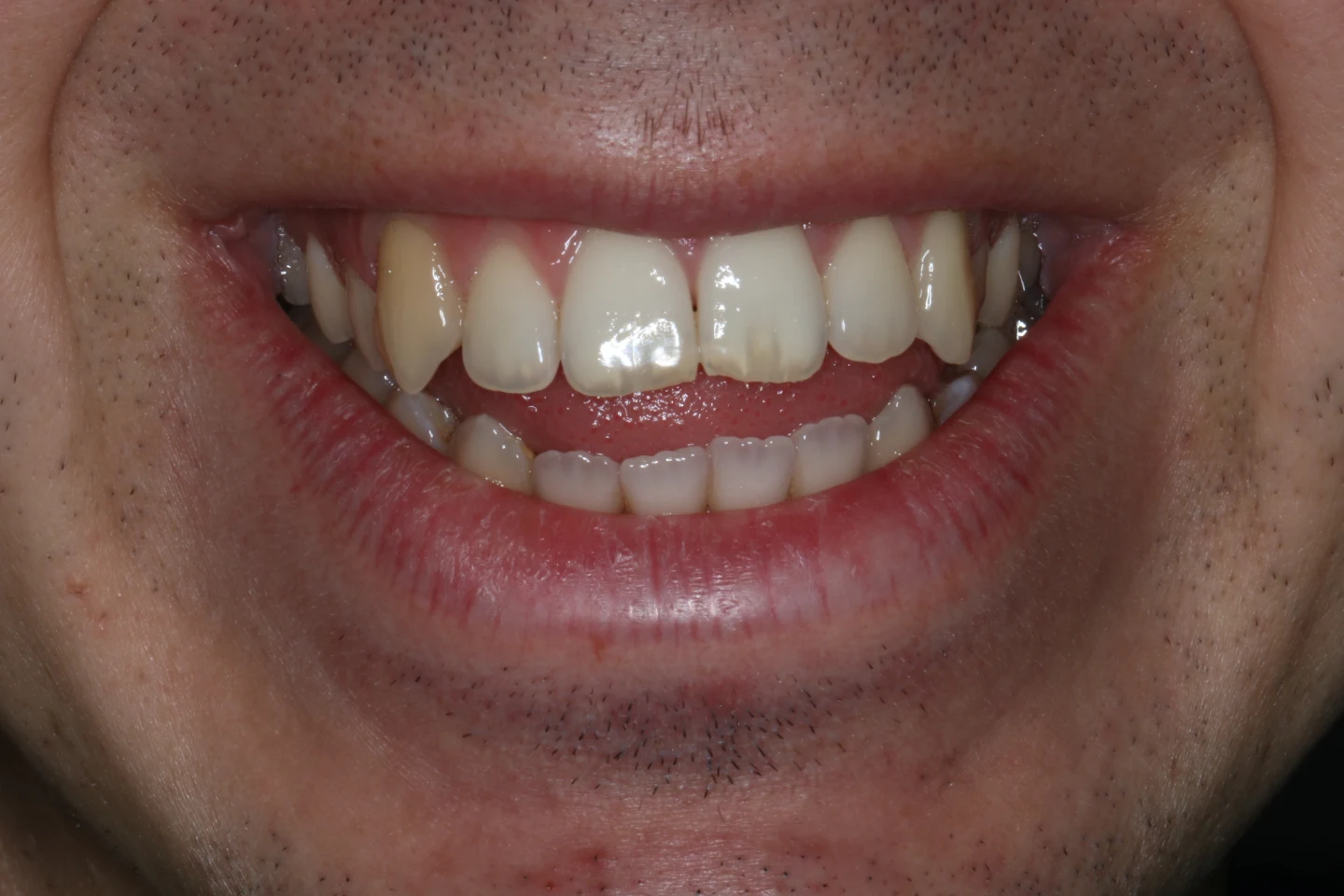 Ryan before after dental treatment