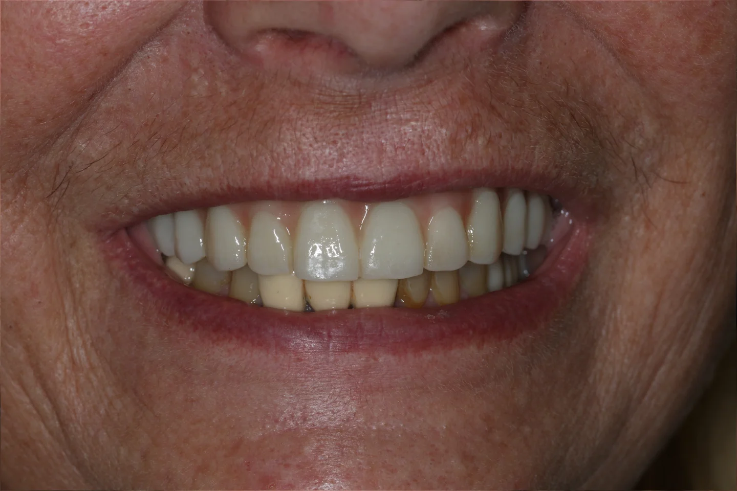 Stella before after dental treatment