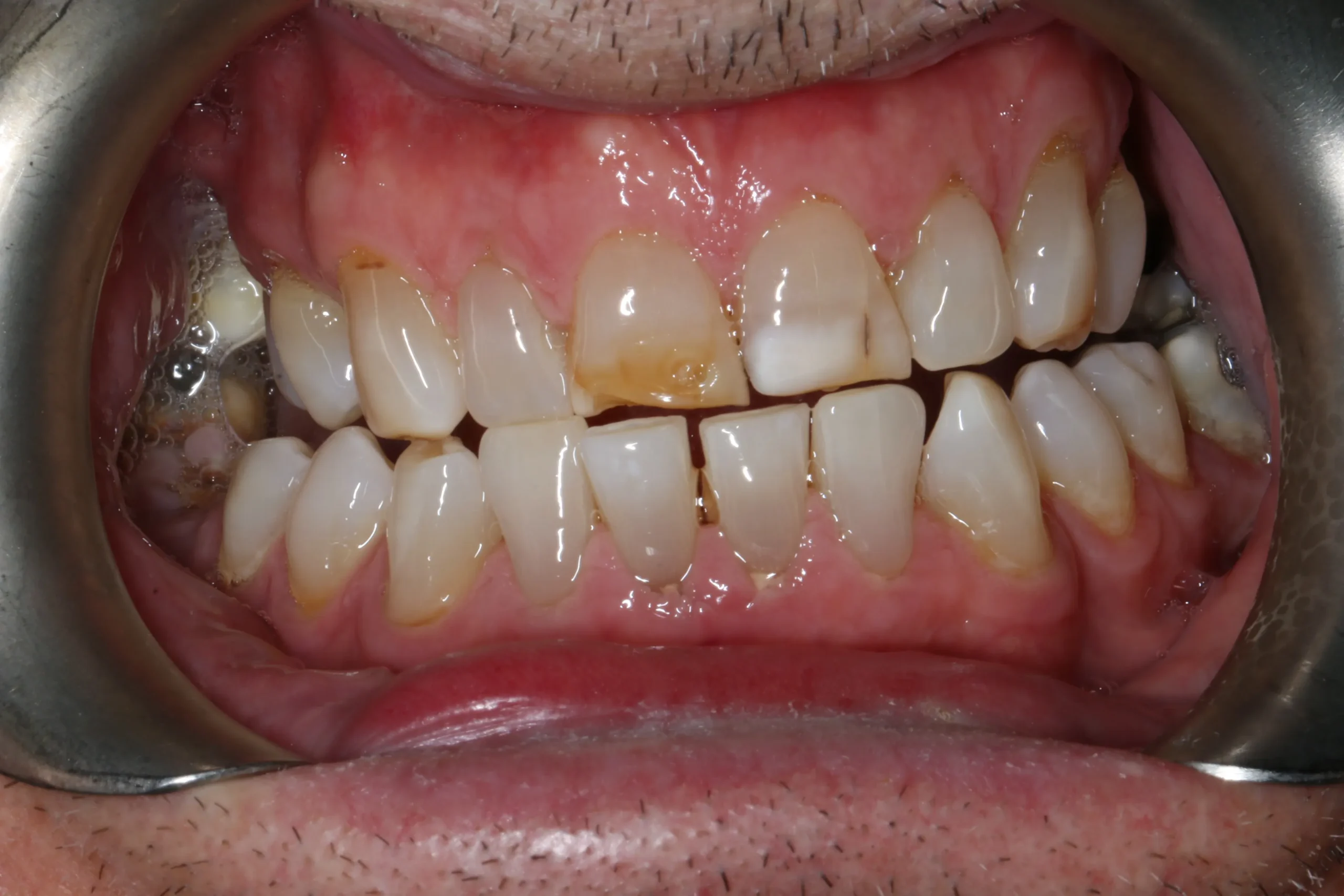 Jim before after dental treatment