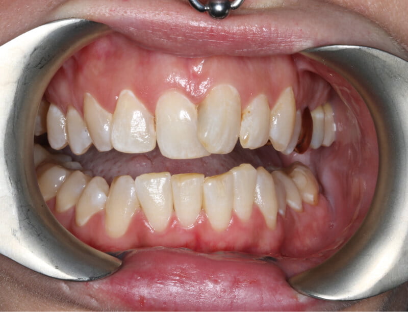 Elise before after dental treatment