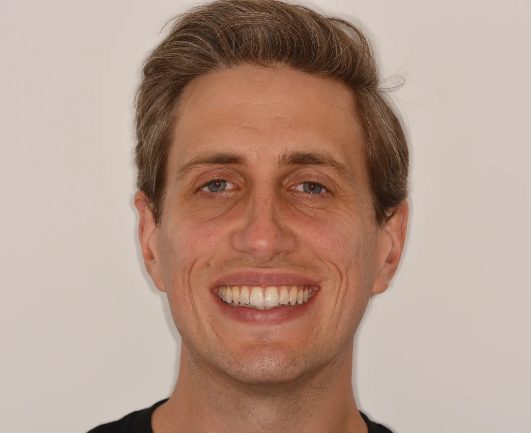 Brad before after dental treatment