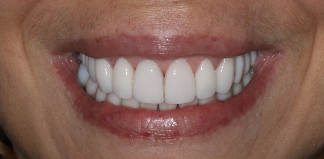 Georgette before after dental treatment