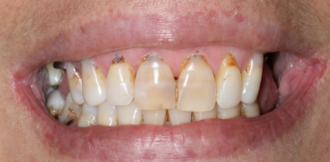 Georgette before after dental treatment