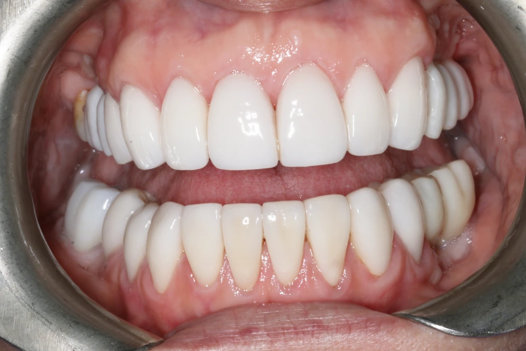 Georgette before after dental treatment