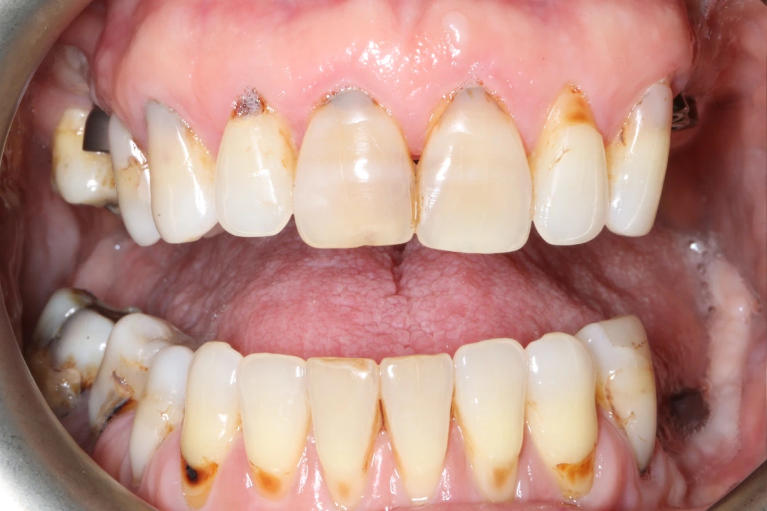 Georgette before after dental treatment