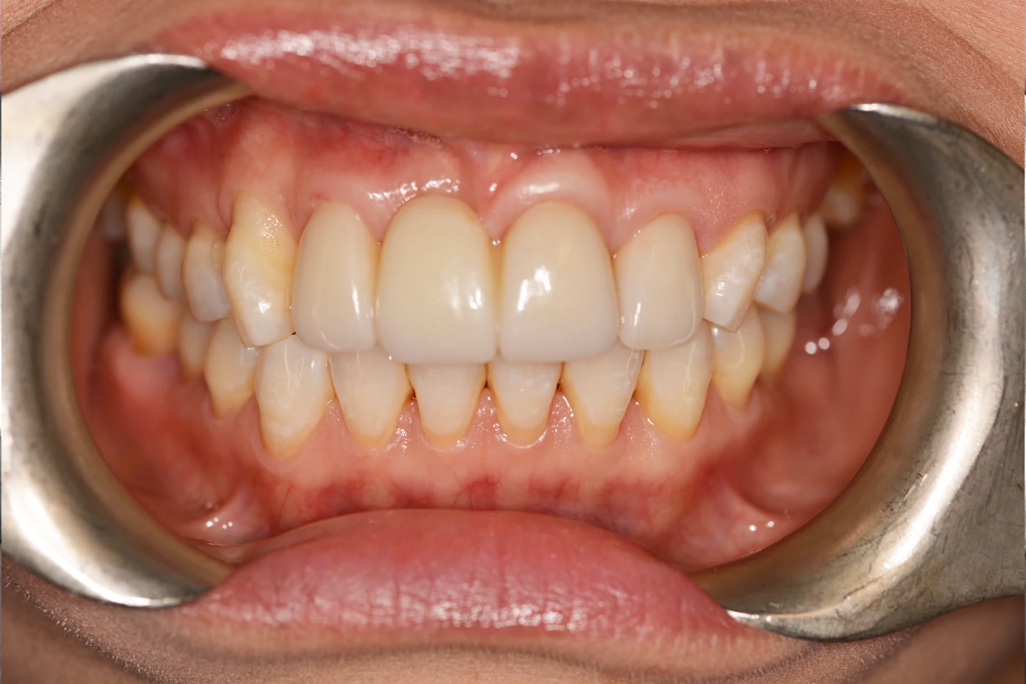 Jasmine before after dental treatment