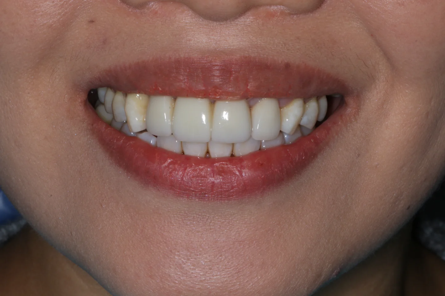 Jasmine before after dental treatment