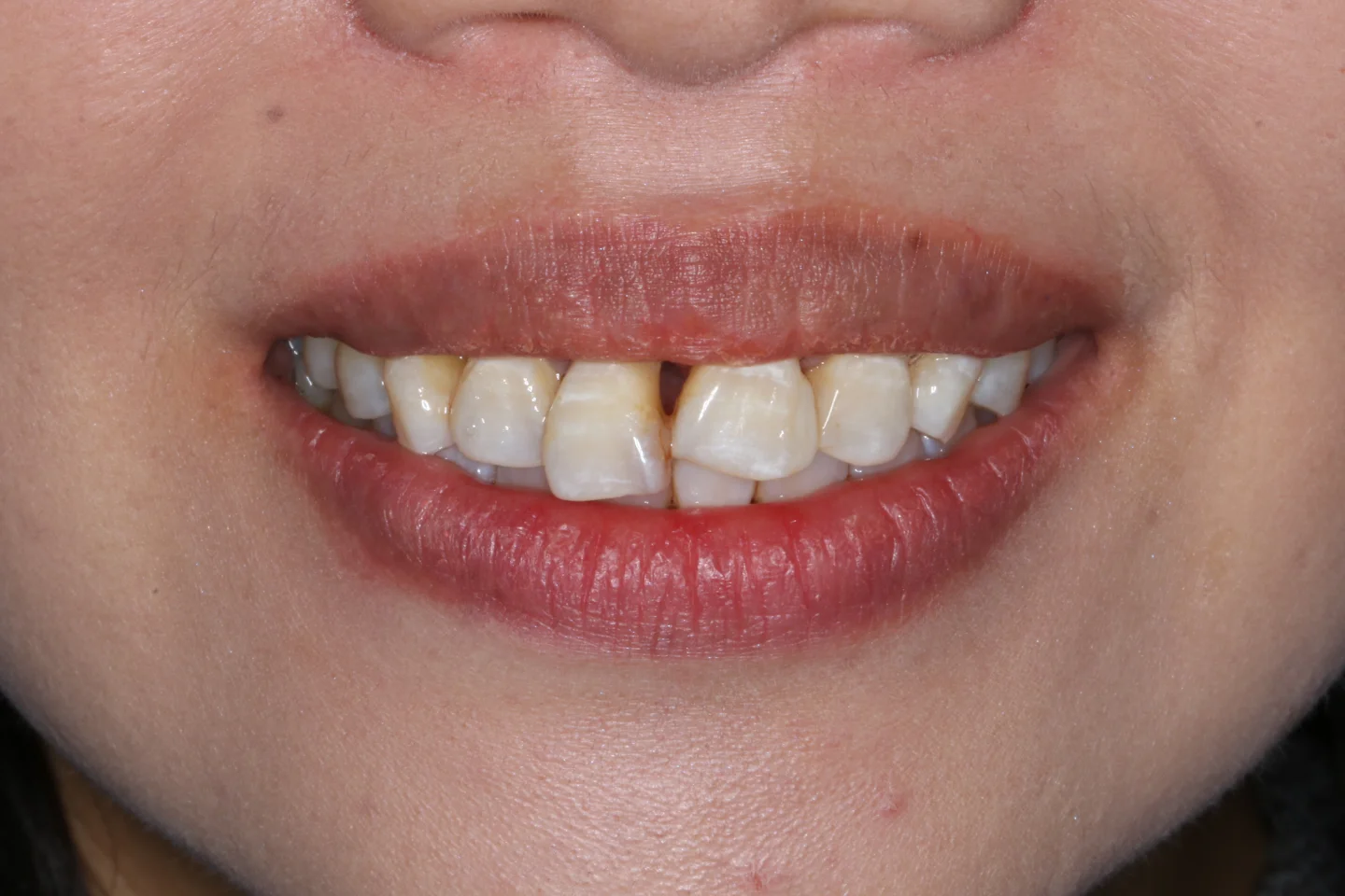 Jasmine before after dental treatment