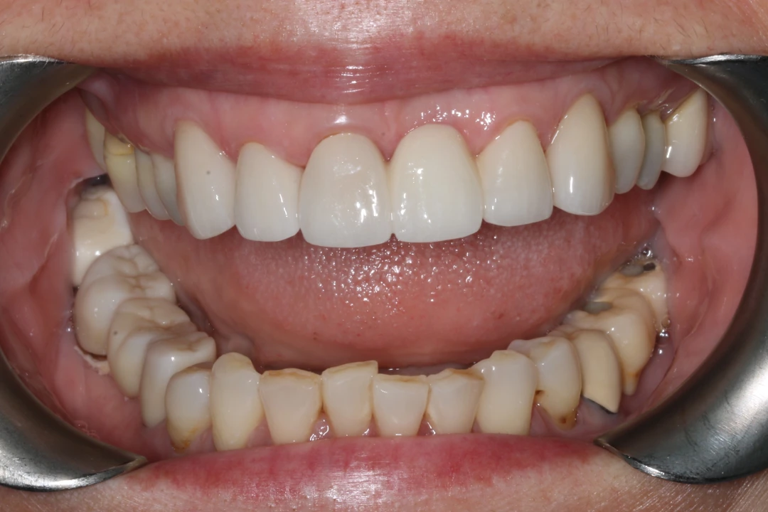 Sew Chin before after dental treatment