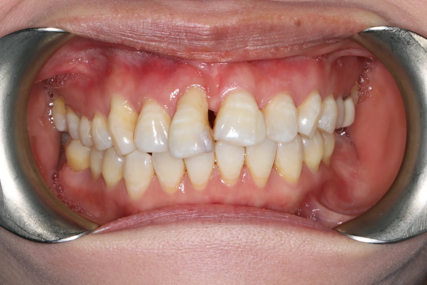 Jasmine before after dental treatment