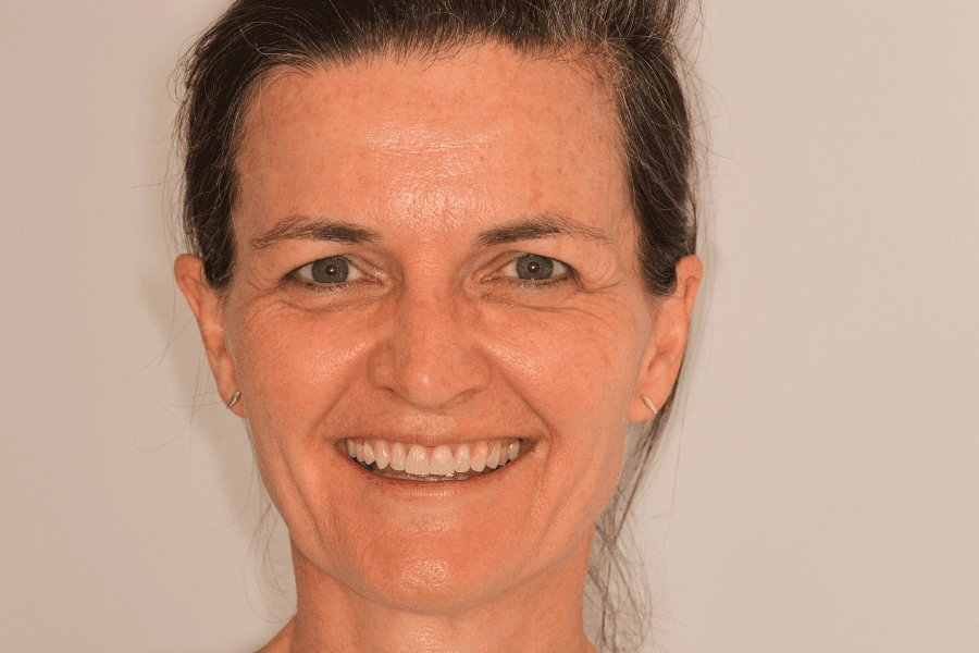 Cathy before after dental treatment