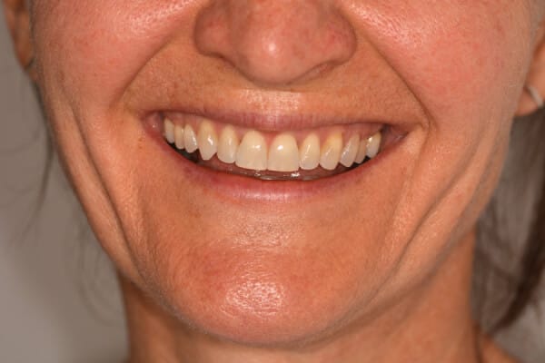 Cathy before after dental treatment