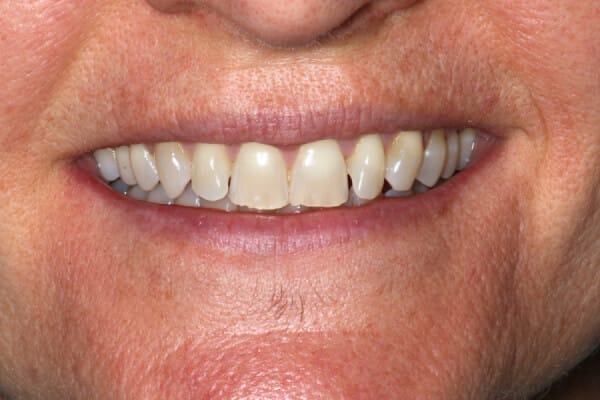 Cathy before after dental treatment