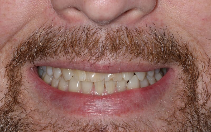 Hayden before after dental treatment