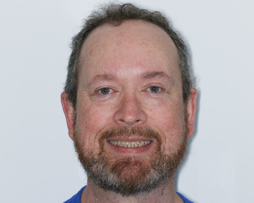 Hayden before after dental treatment