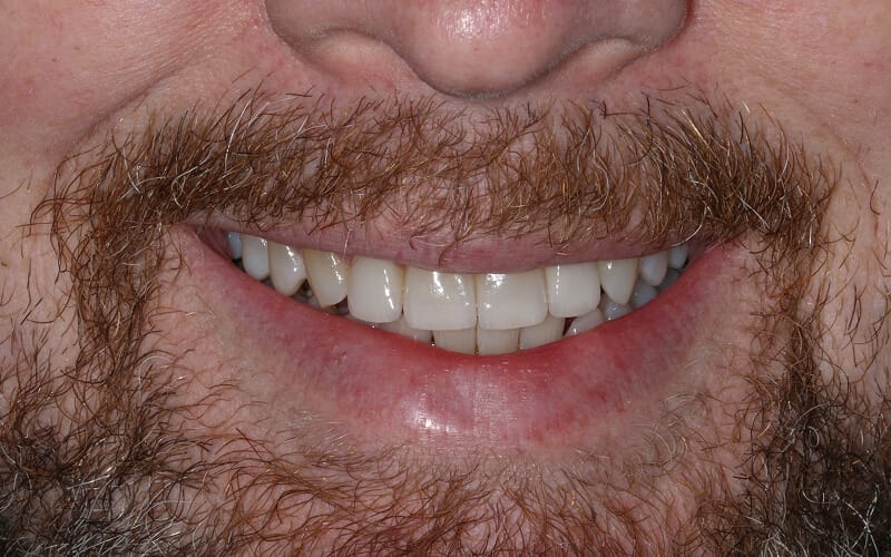 Hayden before after dental treatment