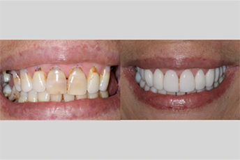 before after photos porcelain veneers