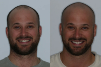 case study porcelain veneers