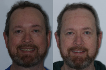 before after porcelain veneers