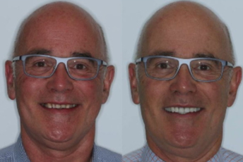 before after porcelain veneers images